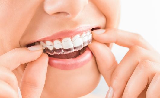 Apparecchio dentale