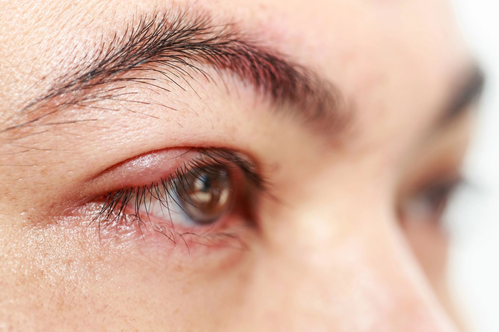 Glaucoma
