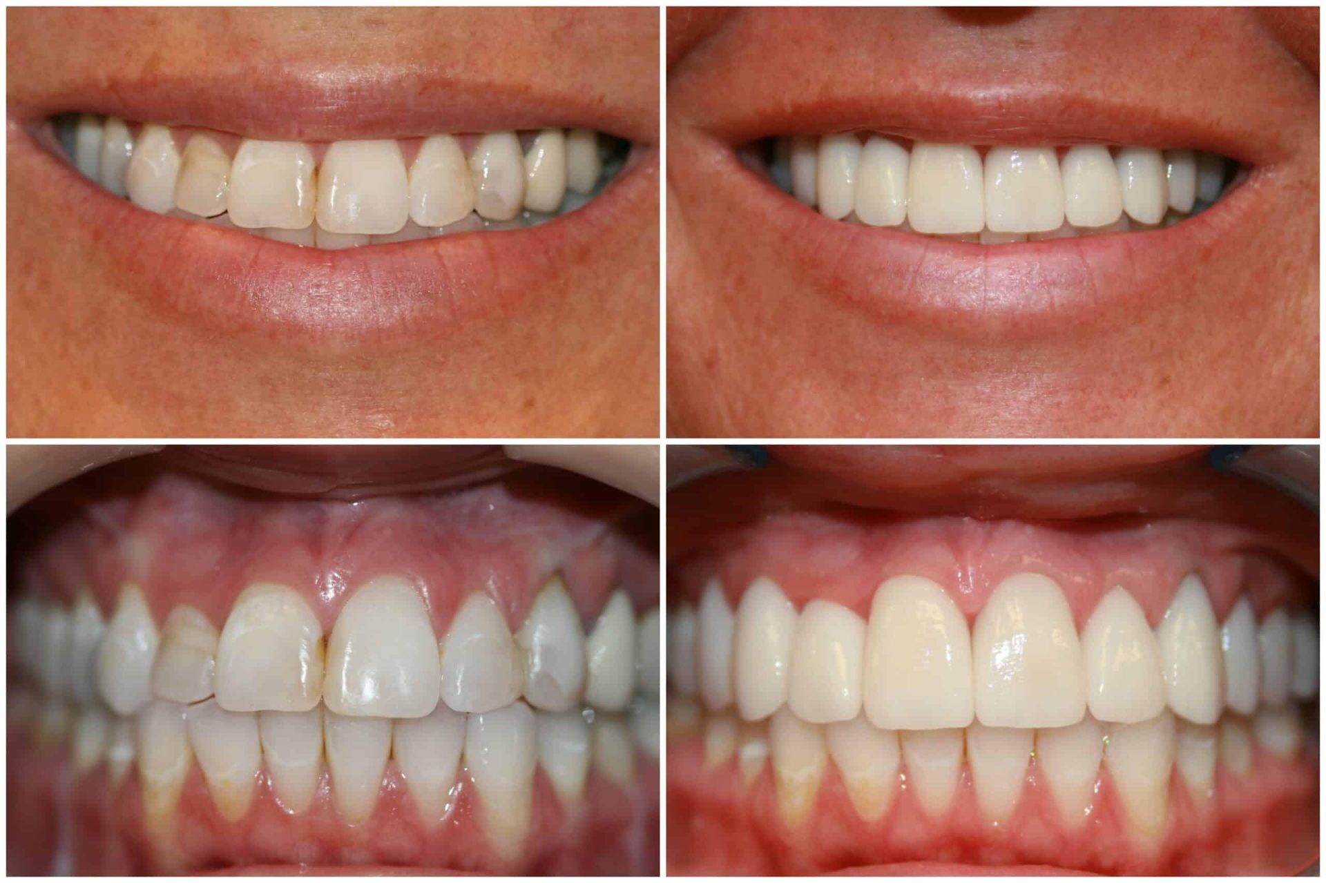 A woman is smiling while sitting in a dental chair.