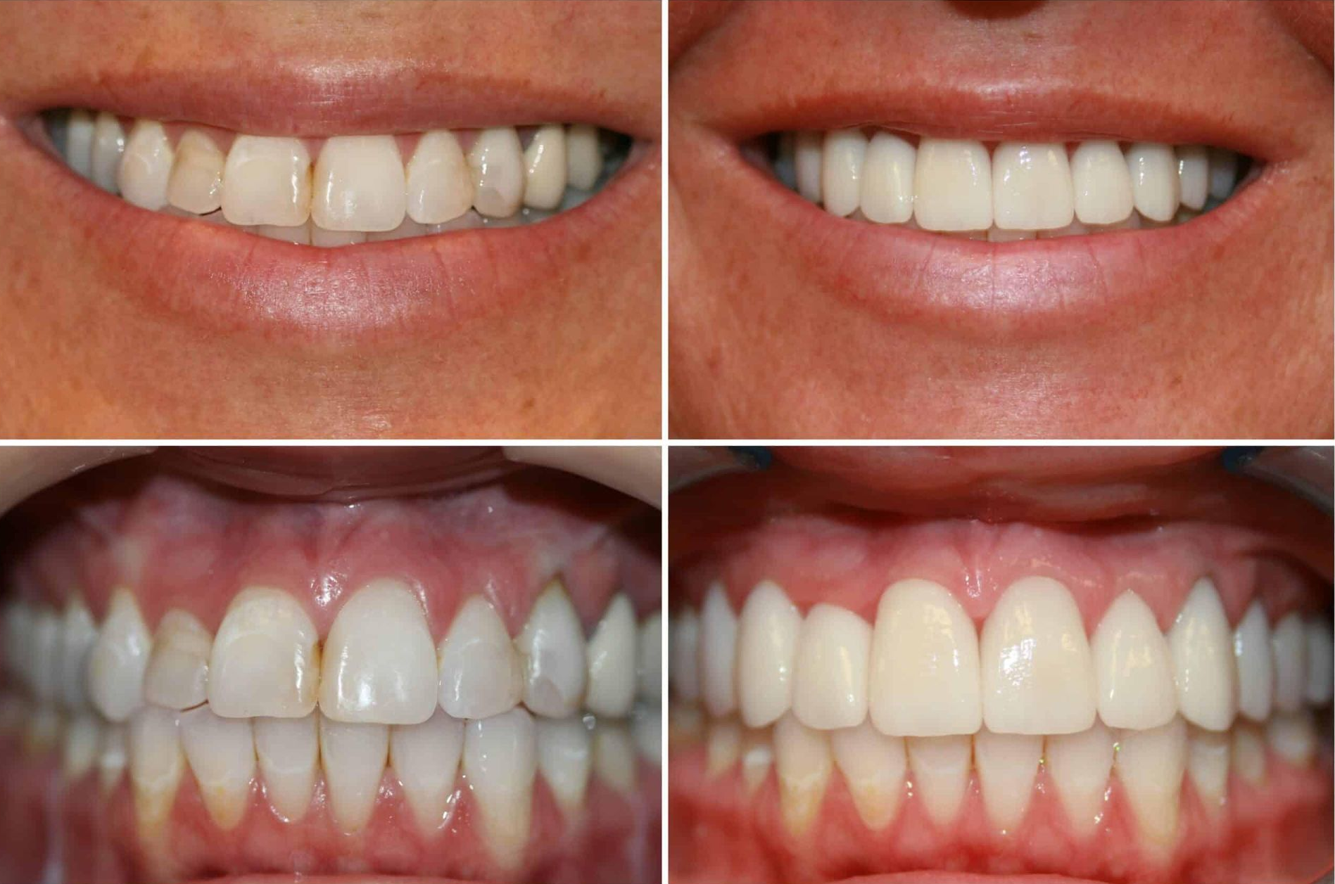 A woman is smiling while having her teeth examined by a dentist.