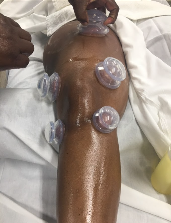 Learning how to do cupping massage