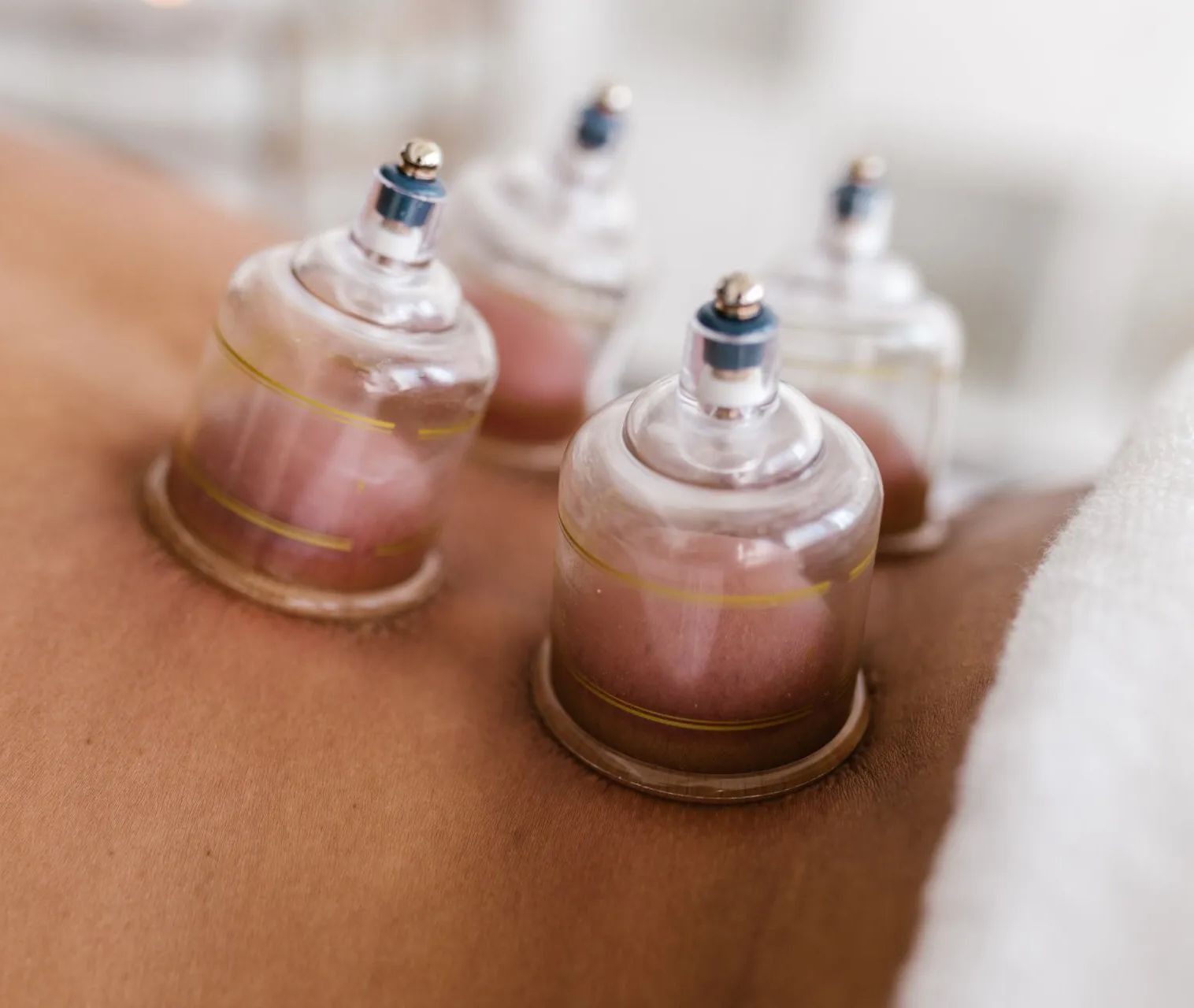 Drie zuignappen op de rug van een persoon tijdens cuppingtherapie.