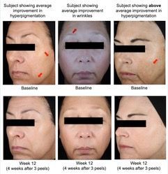 before and after chemical peel photos