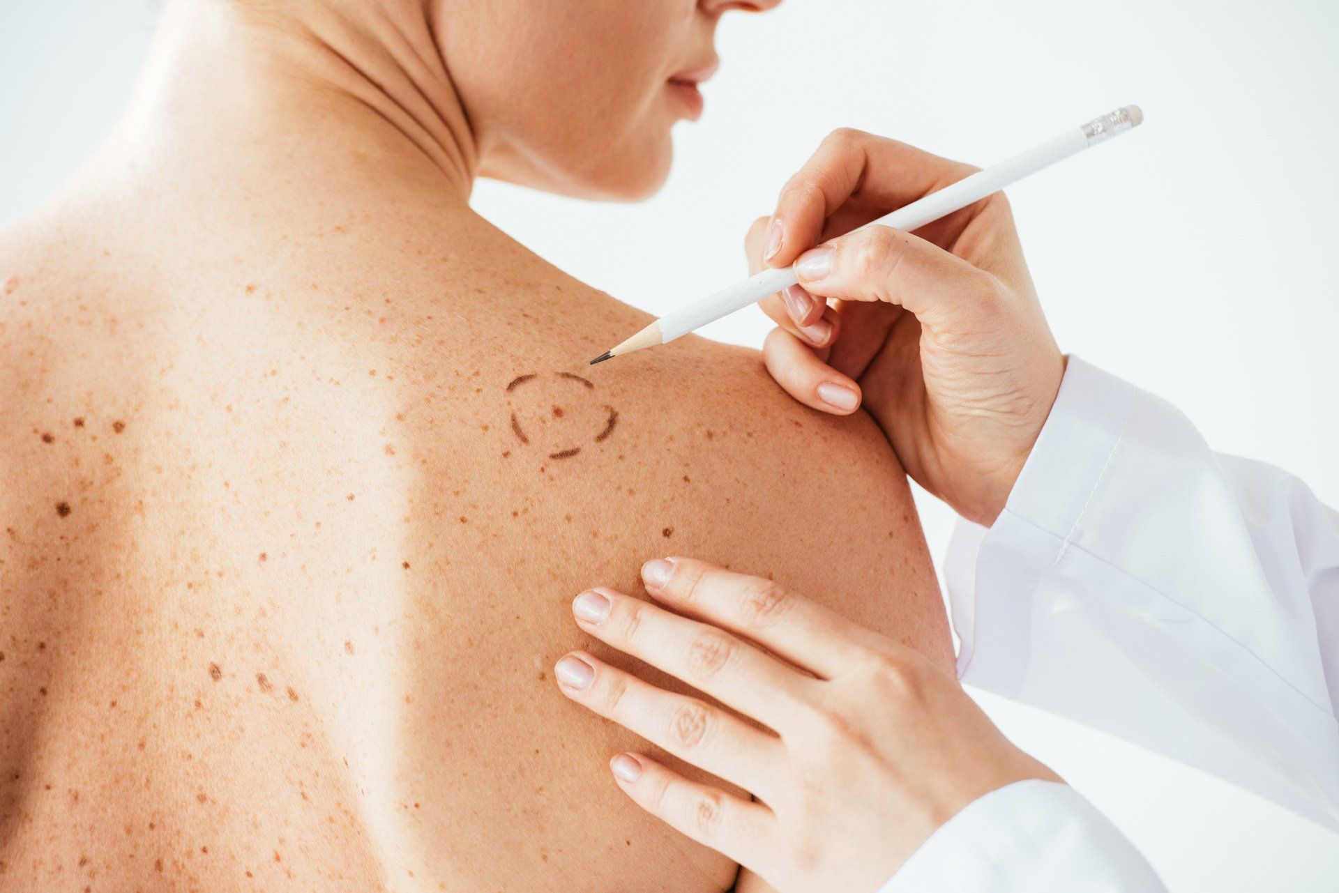dermatologist circling mole on shoulder