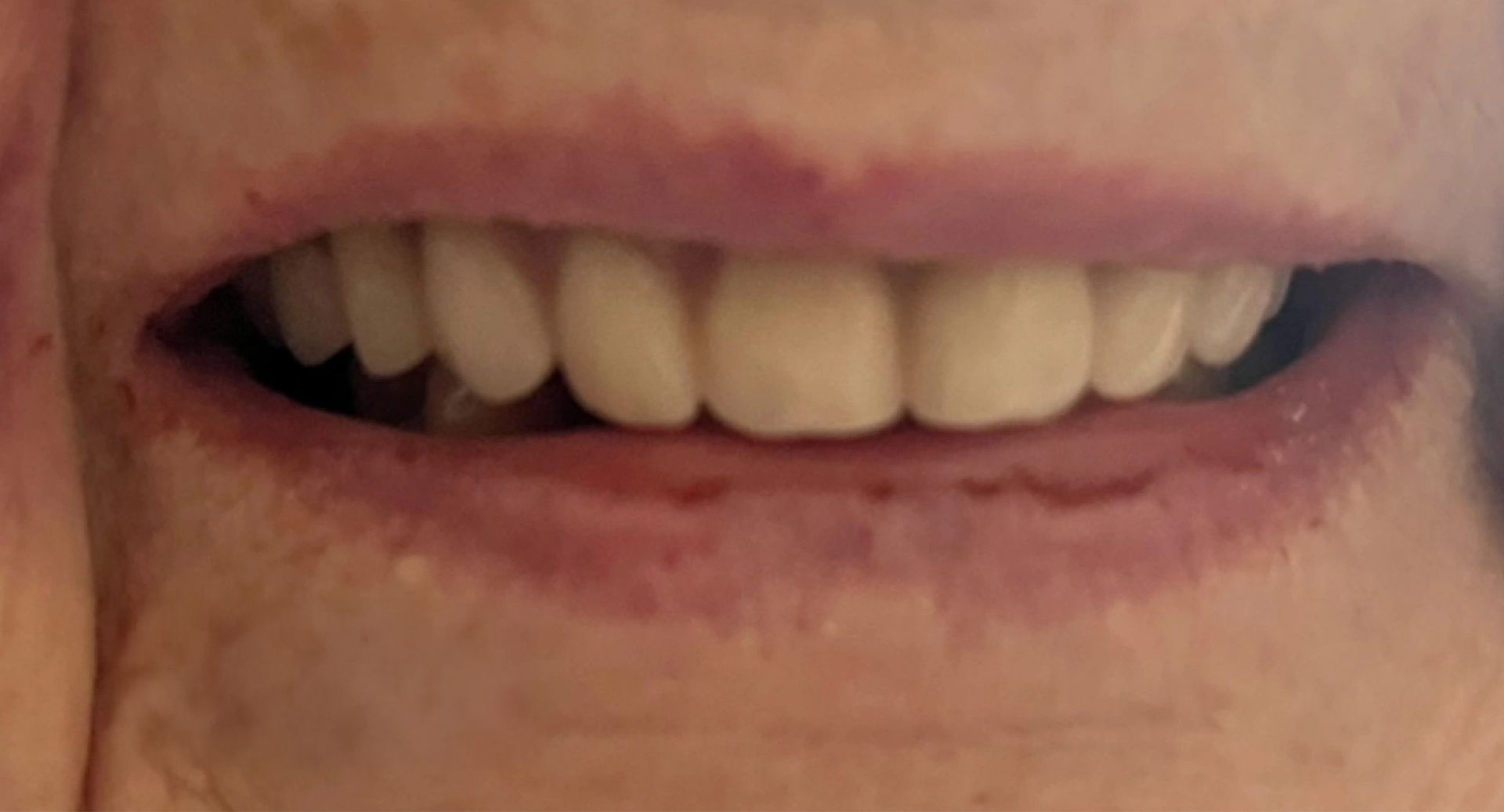 Angel Denture Clinic - Before and After Gallery