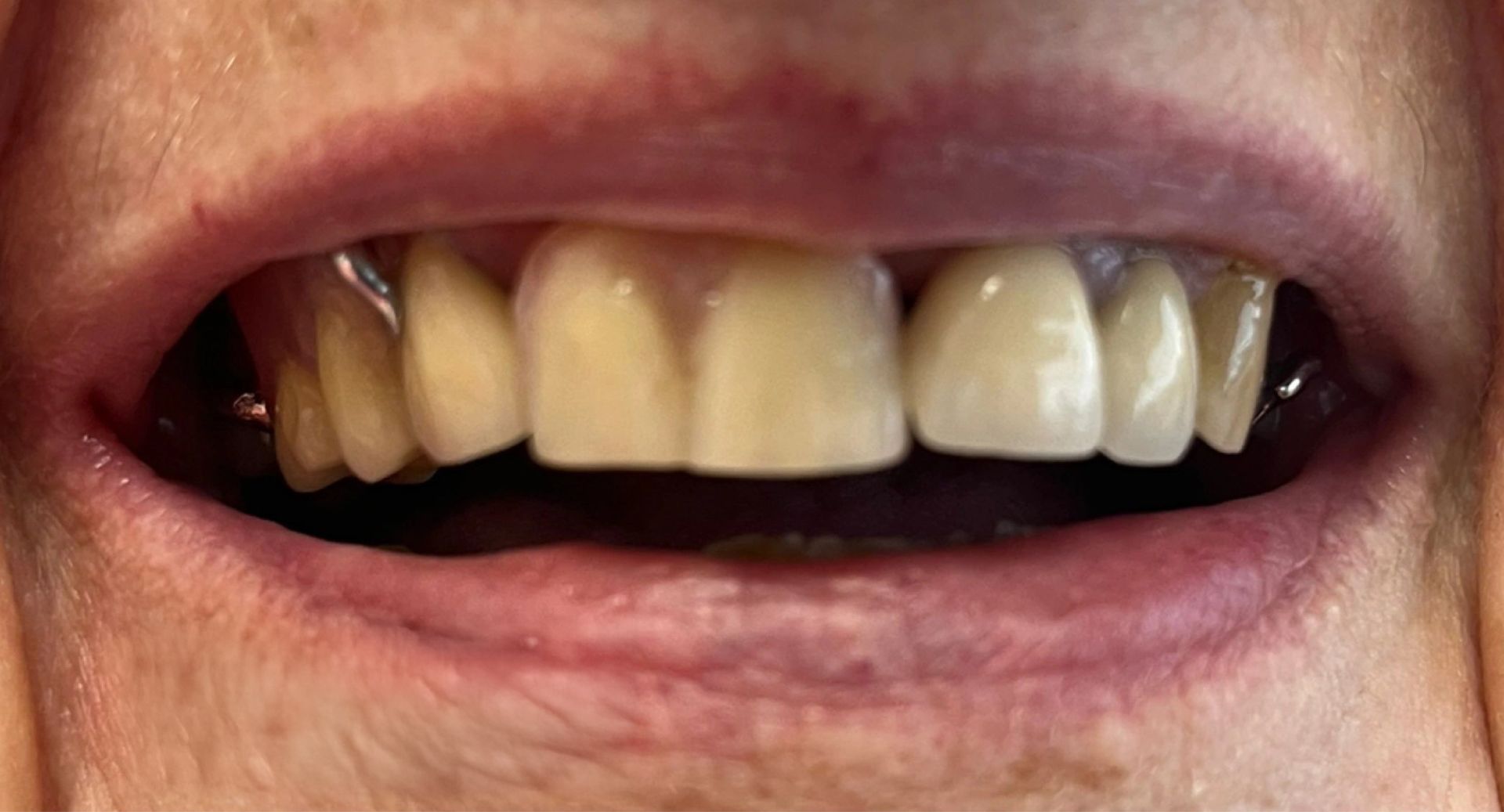 Angel Denture Clinic - Before and After Gallery
