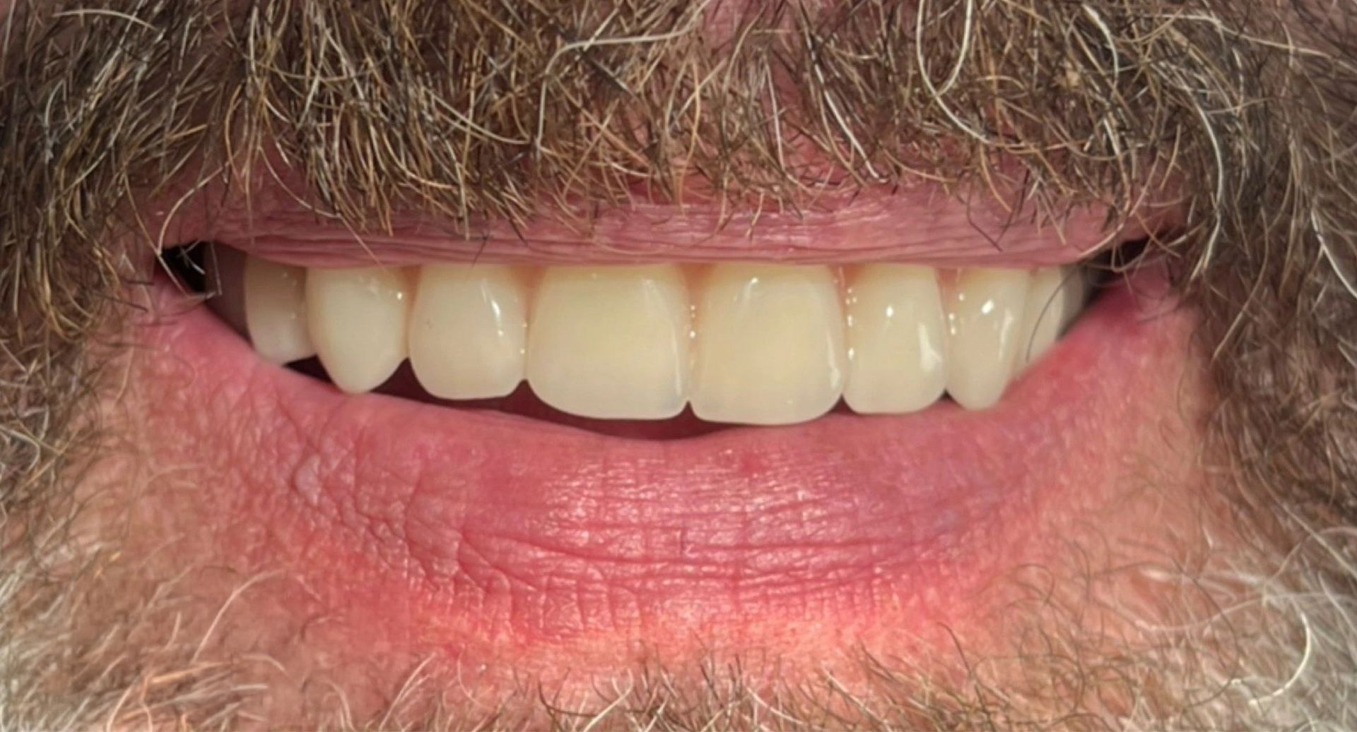 Angel Denture Clinic - Before and After Gallery