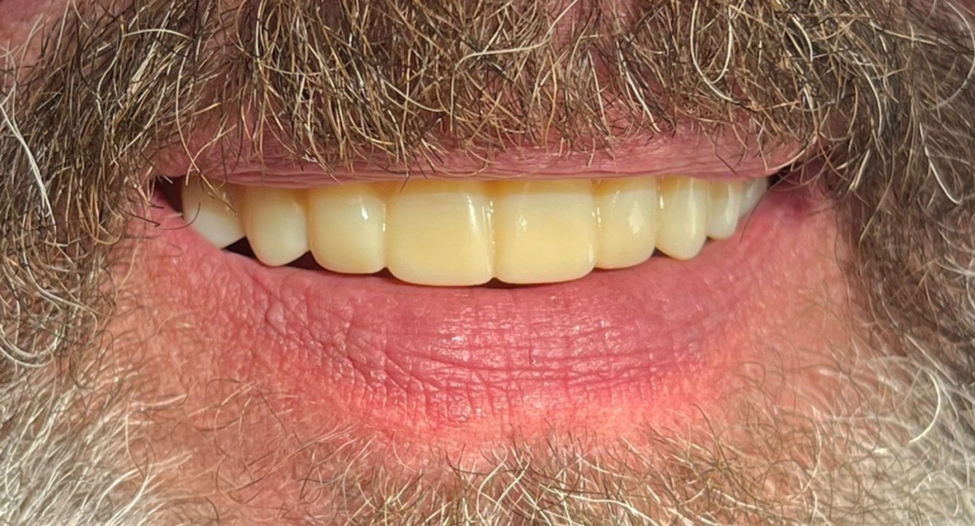 Angel Denture Clinic - Before and After Gallery