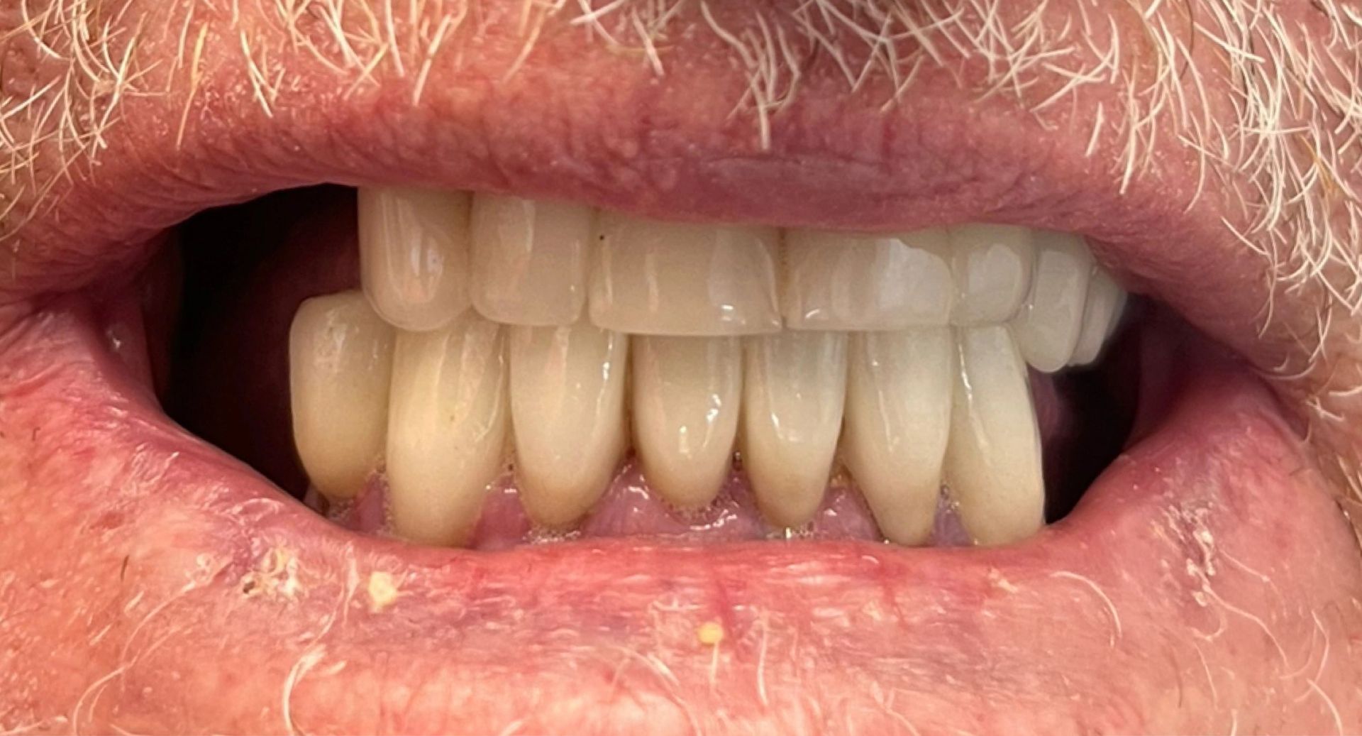 Angel Denture Clinic - Before and After Gallery