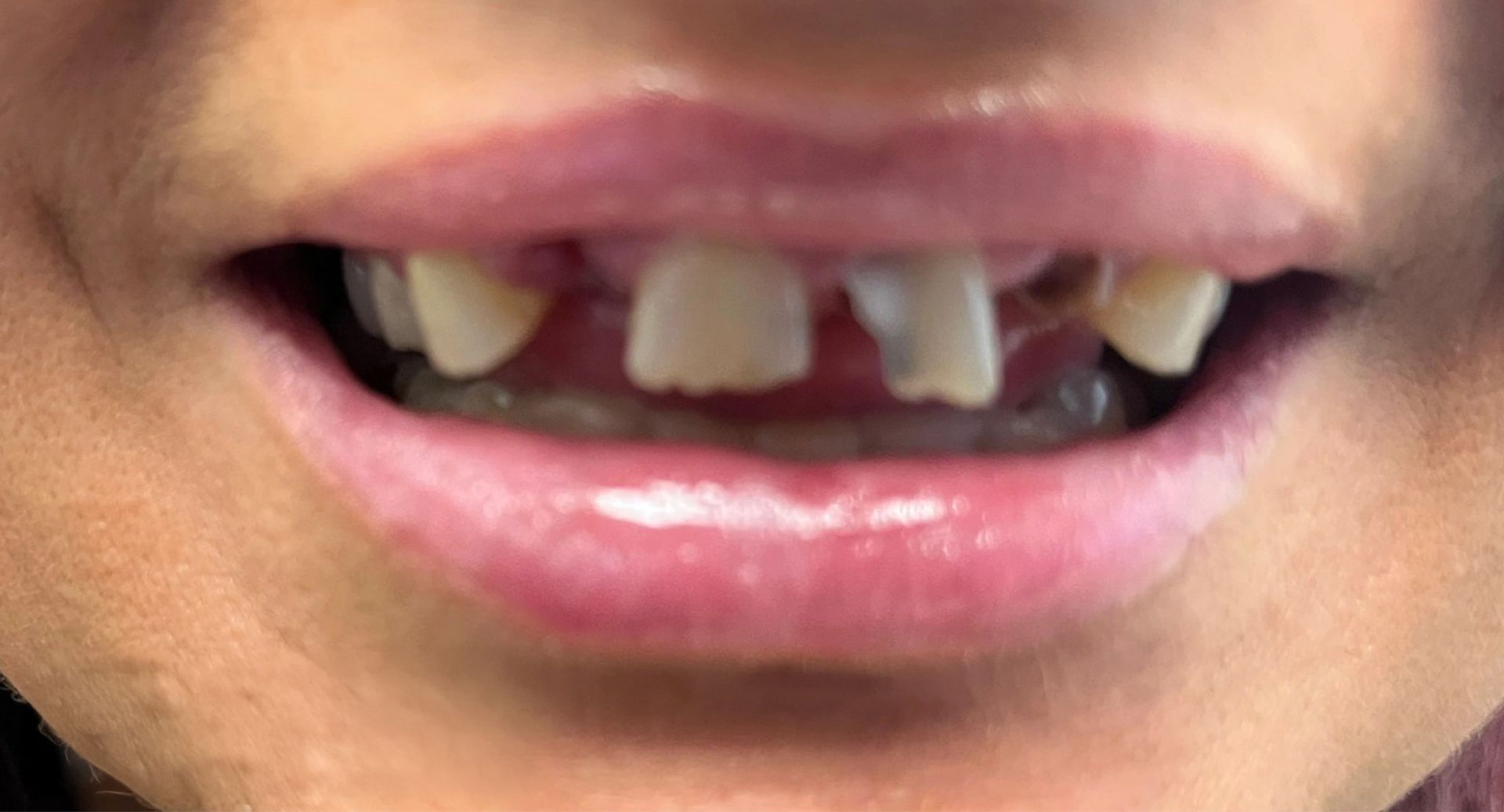 Angel Denture Clinic- Before and After Gallery