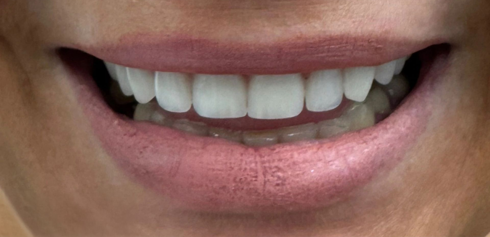 Angel Denture Clinic - Before and After Gallery