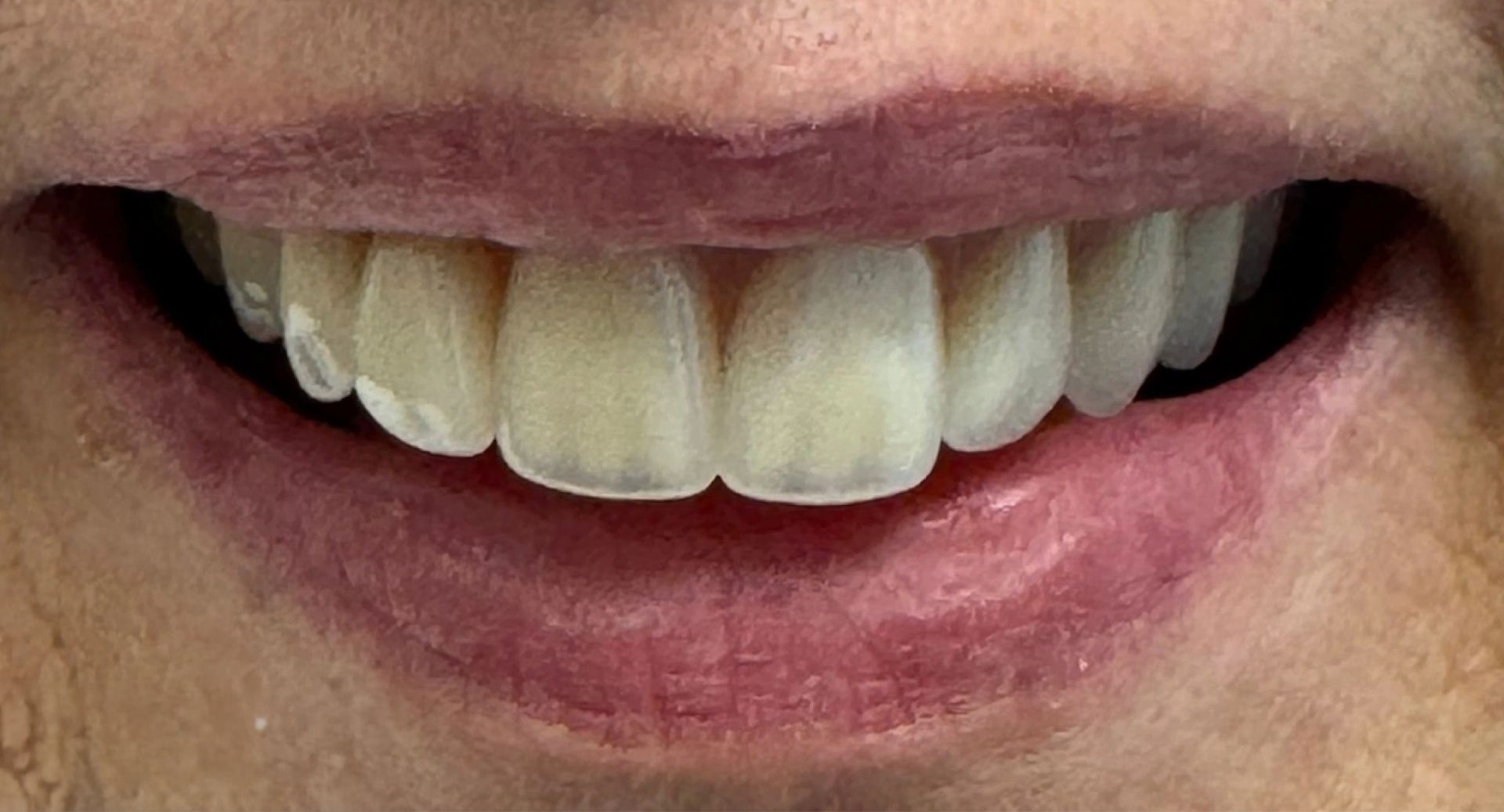 Angel Denture Clinic - Before and After Gallery