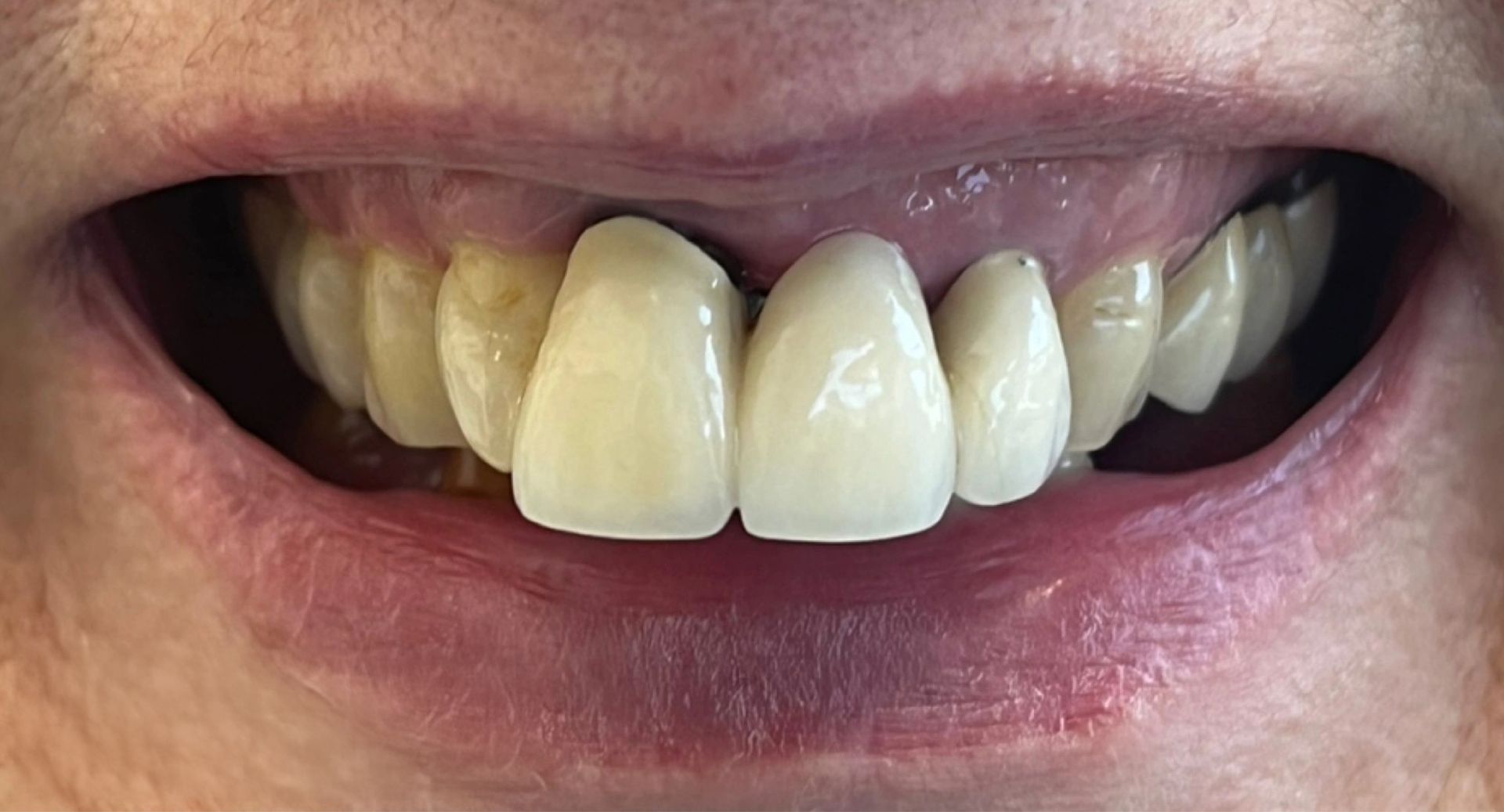 Angel Denture Clinic - Before and After Gallery