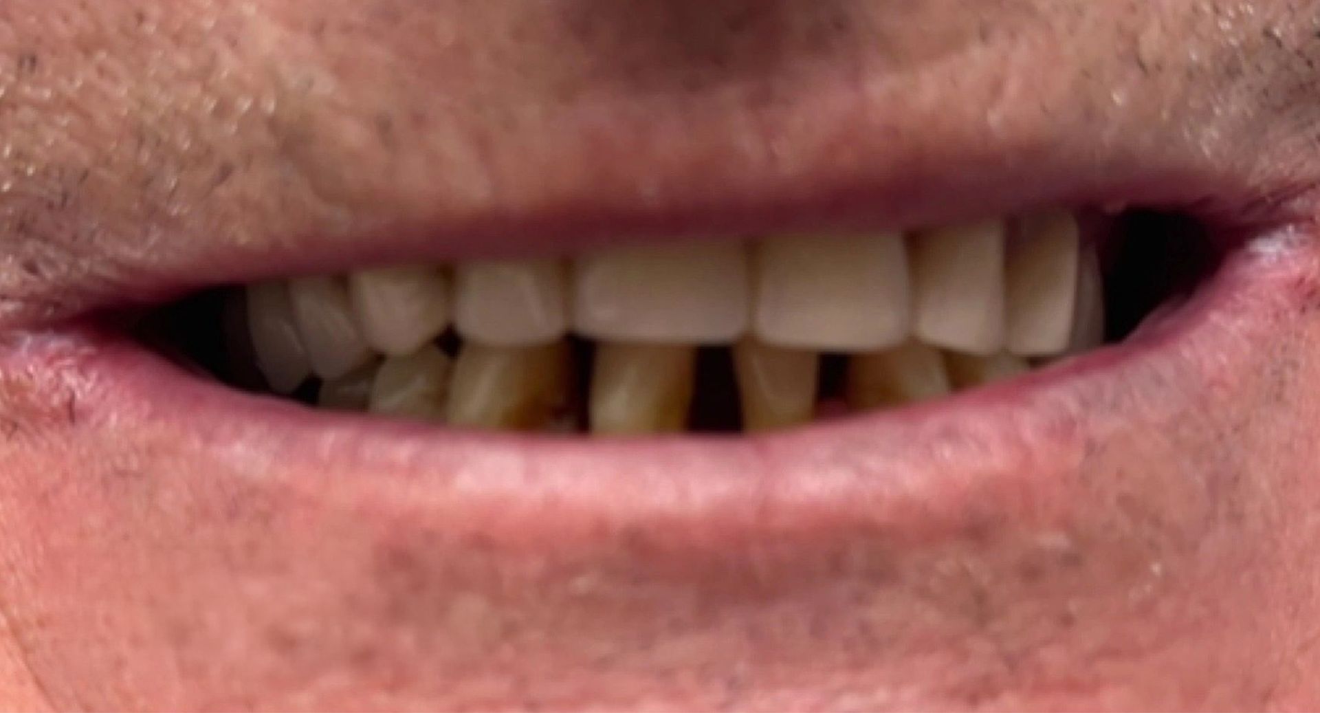 Angel Denture Clinic - Before and After Gallery