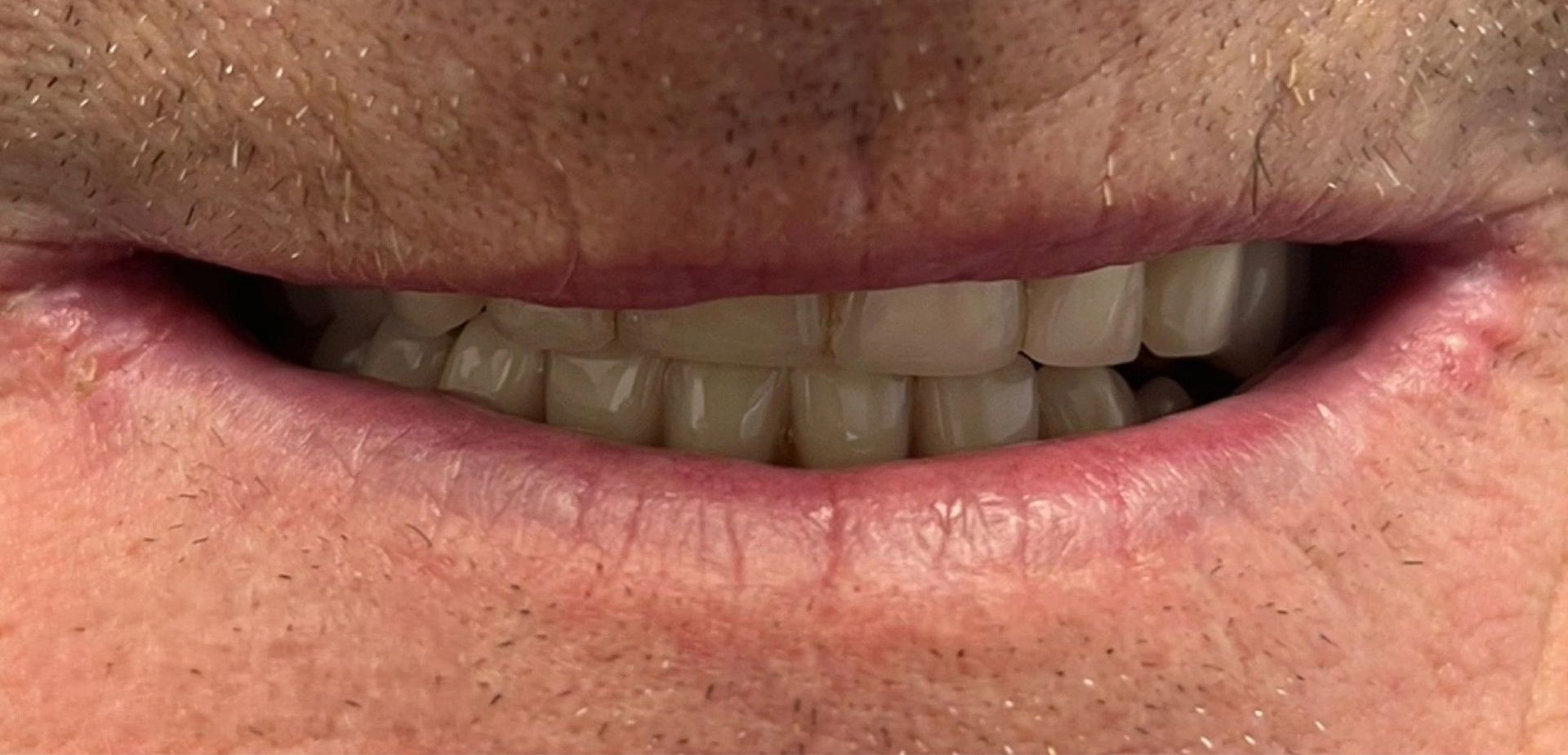 Angel Denture Clinic - Before and After Gallery