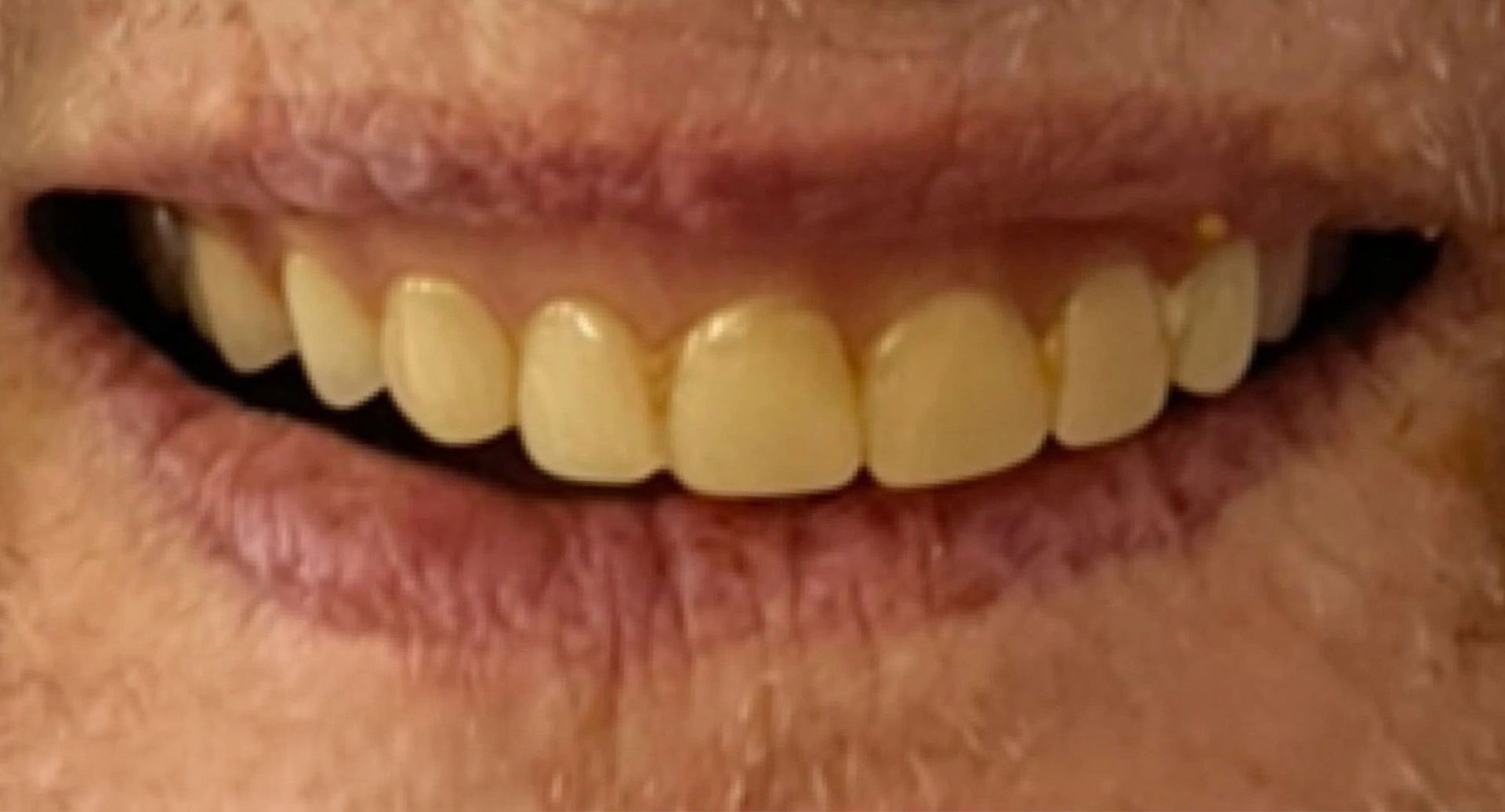 Angel Denture Clinic - Before and After Gallery