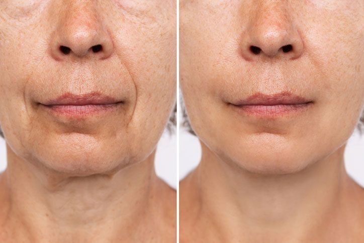 Beautician doctor with botulinum toxin syringe making injection to to remove crow's feet. Cheek volume enhance mesotherapy. Anti-aging treatment and face lift in cosmetology clinic