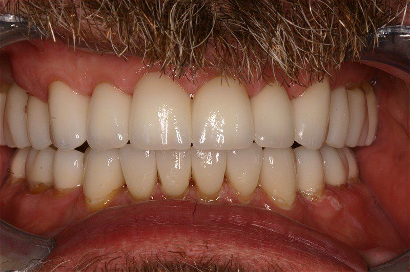 White Teeth — Tonganoxie, KS — Tonganoxie Dental