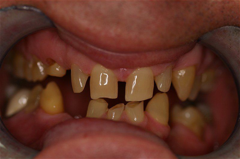 Yellow Teeth — Tonganoxie, KS — Tonganoxie Dental