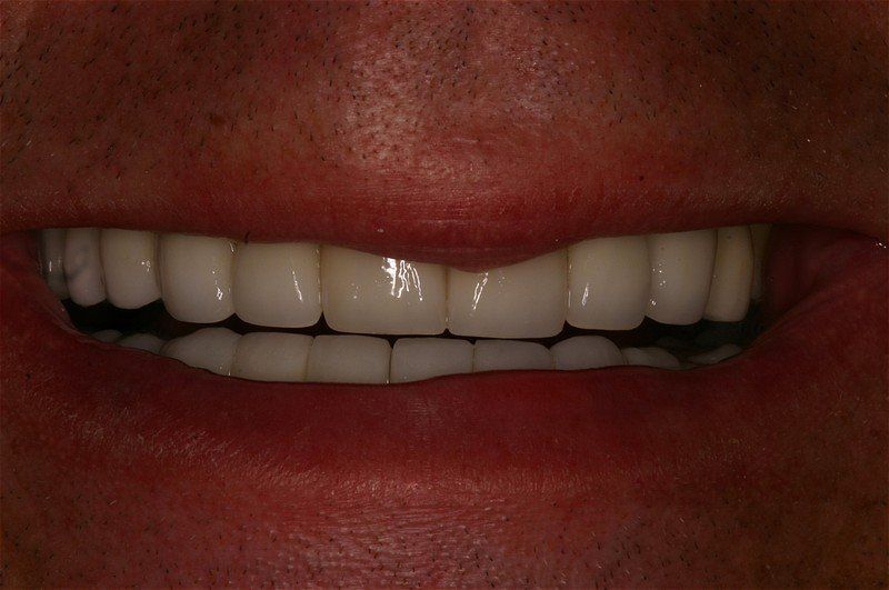 Porcelain Crowns And Veneers — Tonganoxie, KS — Tonganoxie Dental