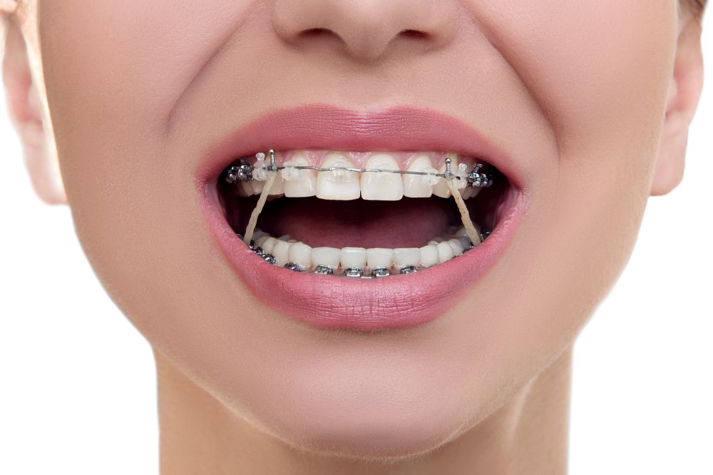 Close-up of a Person With Braces, Showing Teeth — Tamworth Orthocare In Scone, NSW