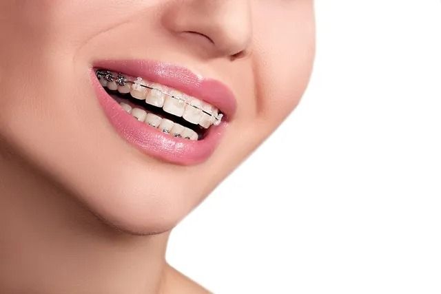 Close-up of a Person Smiling, Showing Teeth With Clear Braces — Tamworth Orthocare In Armidale, NSW