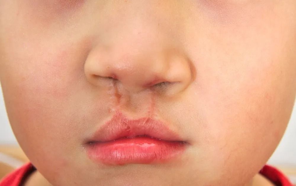 Close-up of Child's Face With a Repaired Cleft Lip and Palate  — Tamworth Orthocare In Tamworth, NSW