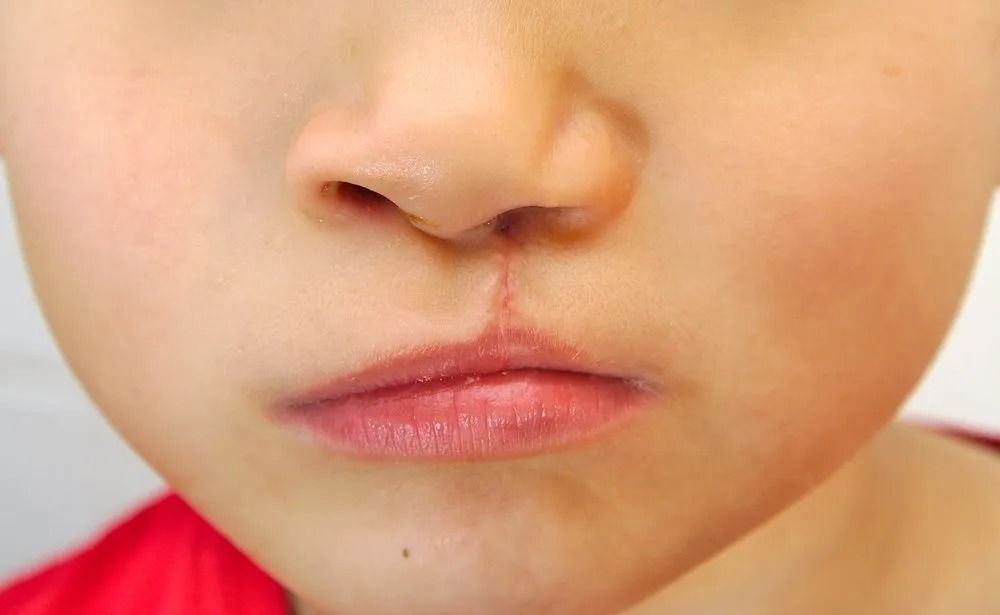 Close-up of a Child's Face; a Vertical Scar on Upper Lip — Tamworth Orthocare In Tamworth, NSW