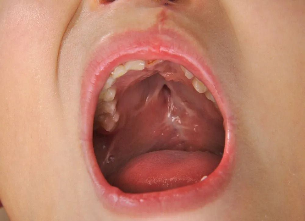 Mouth of a Child With Cleft Palate, Showing an Opening in the Roof of the Mouth — Tamworth Orthocare In Armidale, NSW