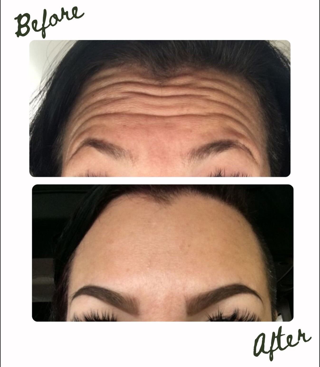 Before-and-after close-up of forehead wrinkles, with smooth skin in the after image.