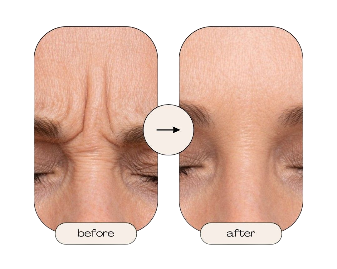Before-and-after close-up of forehead wrinkles, showing smoother skin after treatment.