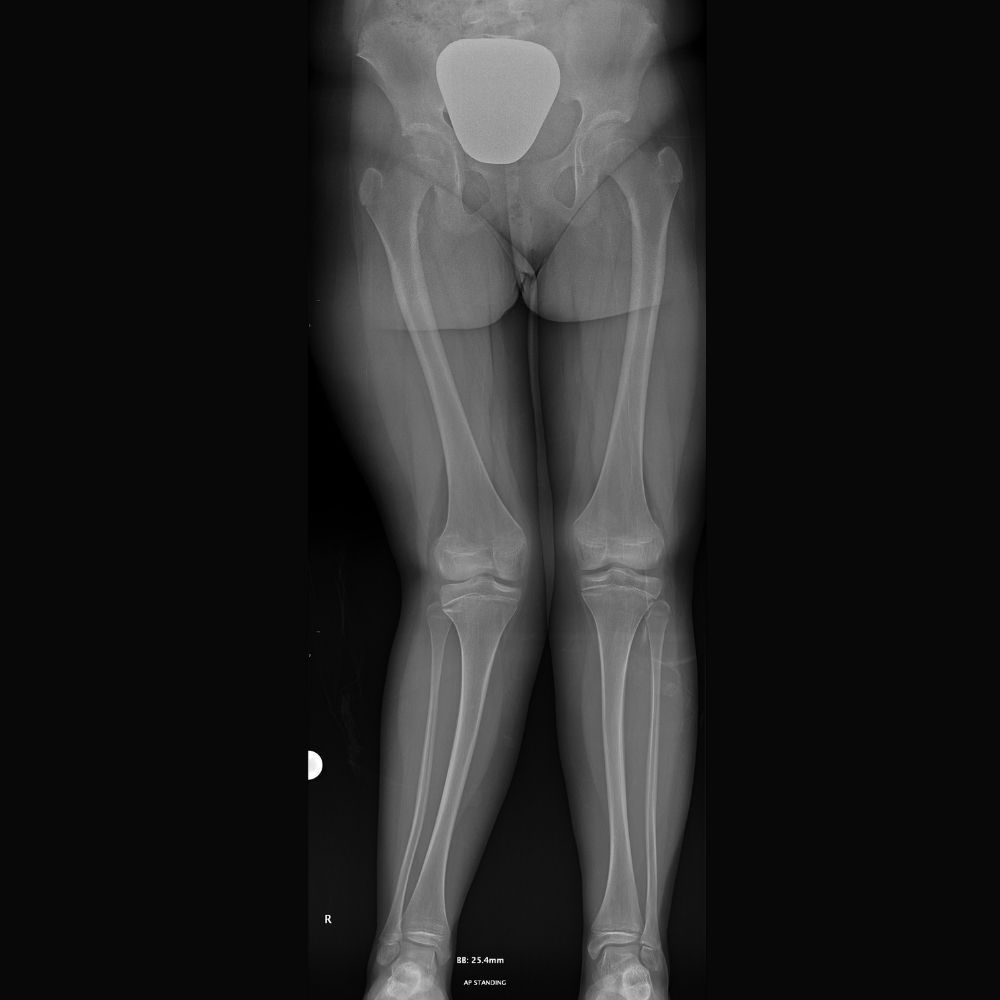 An x-ray of a child 's legs and knee joints.