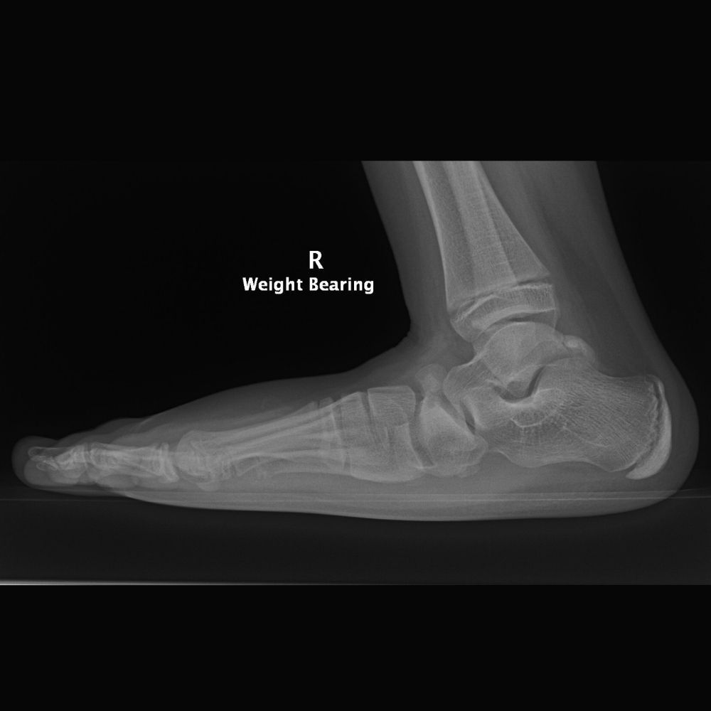 An x-ray of a person 's foot with a weight bearing.
