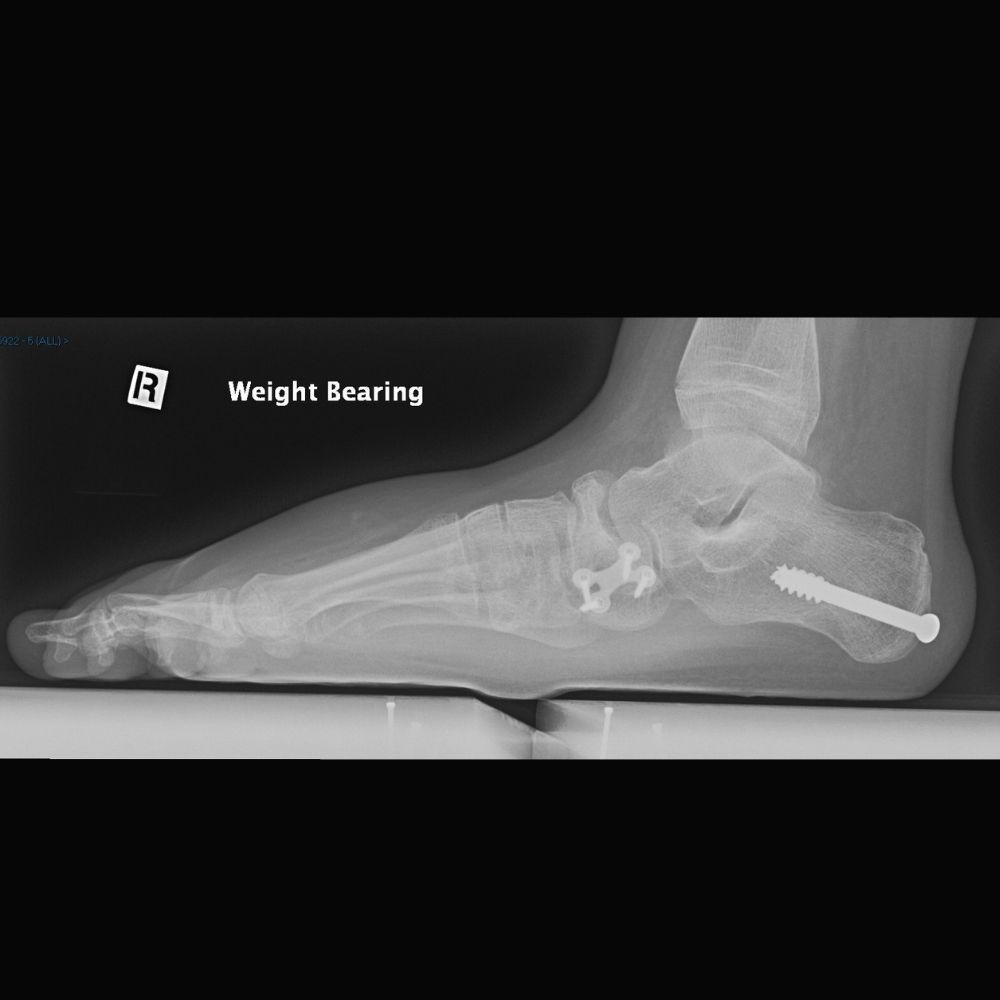 An x-ray of a foot with a screw in it