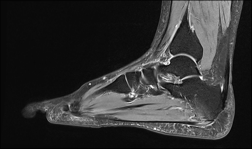 MRI image of plantar fasciitiis