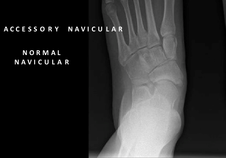 An x-ray of a normal navicular and accessory navicular