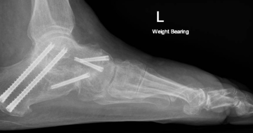 An x-ray of a person 's foot with a weight bearing.