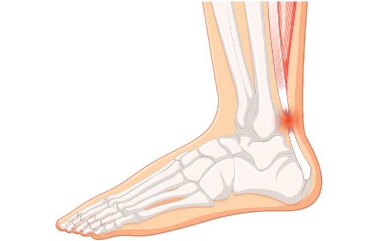 A cartoon illustration of a person 's foot with a broken ankle.
