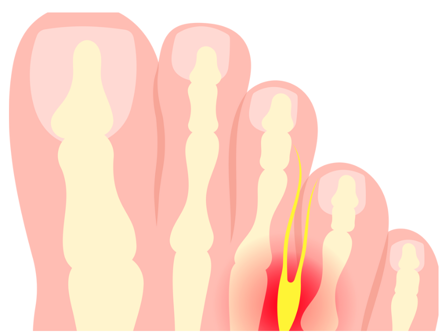 A cartoon illustration of a toe with a red spot on it.