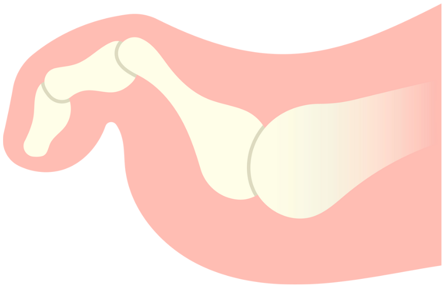 A cartoon illustration of a hand with a broken thumb.