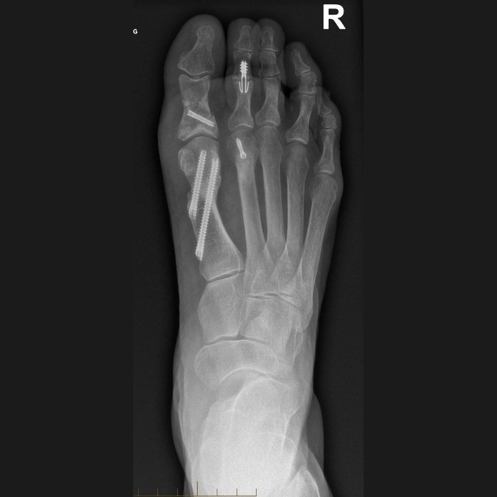 An x-ray of a foot with a screw in it.