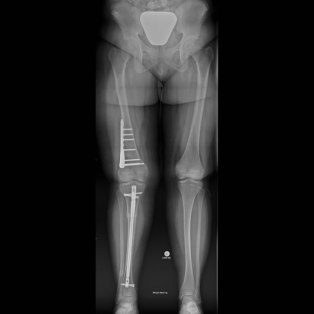 An x-ray of a person 's legs with a knee replacement.