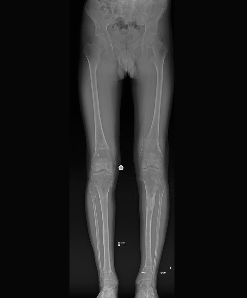An x-ray of a person 's legs with a black background.