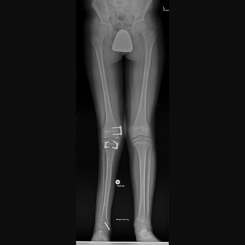 An x-ray of a person 's legs with a knee replacement.