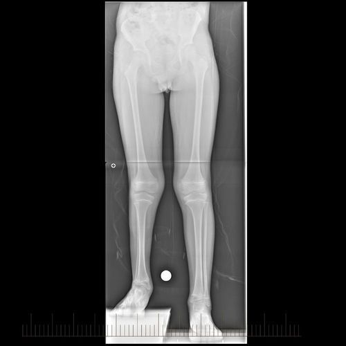 A black and white x-ray of a person 's legs with a ruler.