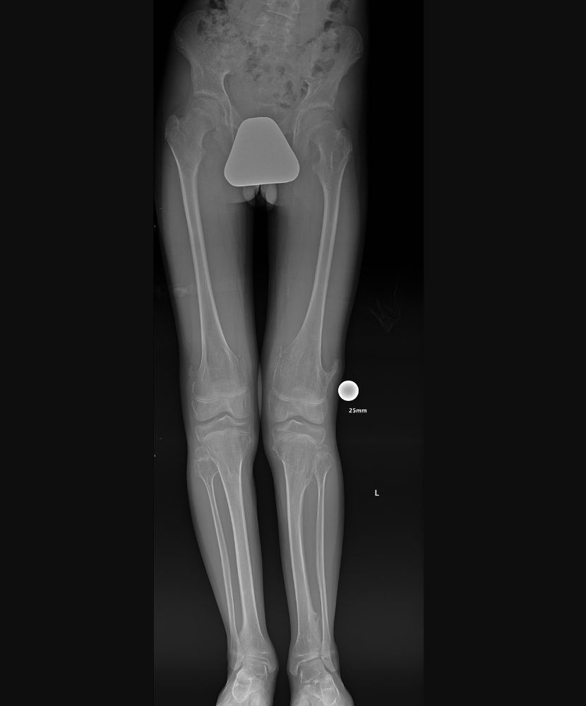 X-ray of patient's knee after surgery