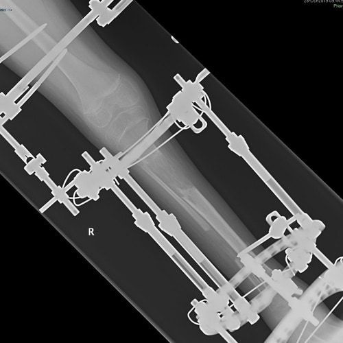 An x-ray of a person 's leg with a broken bone