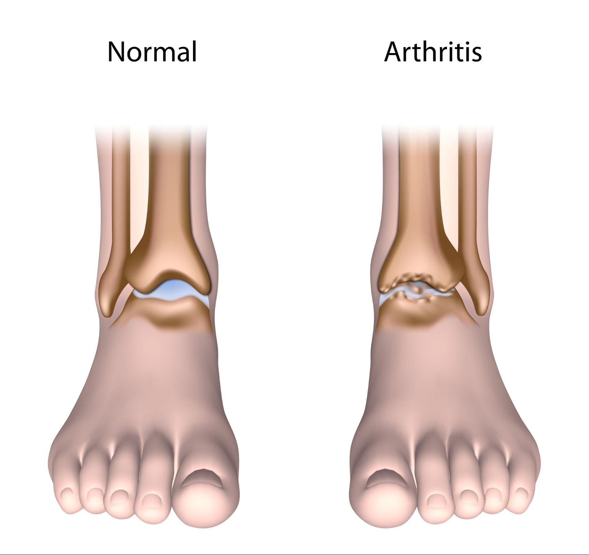 A normal ankle and an ankle with arthritis.