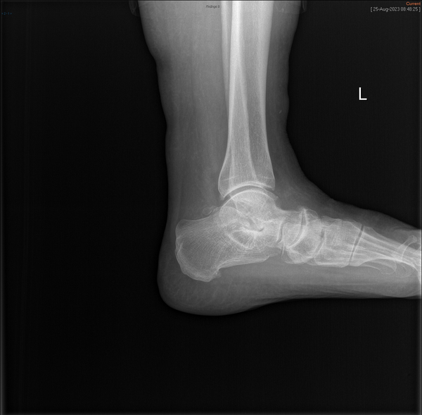 An x-ray of a person 's ankle with the letter l on it.