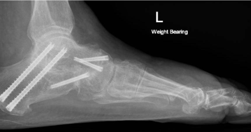 An x-ray of a person 's foot with a screw in it.